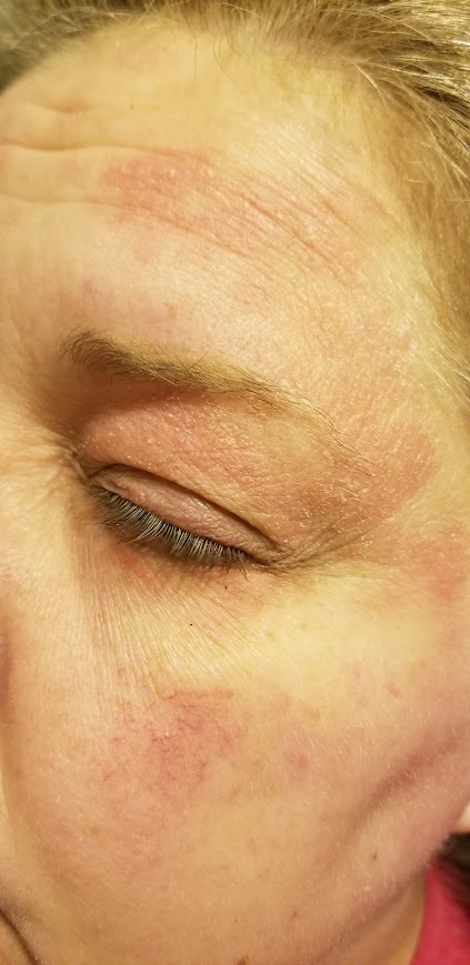 Picture of Cheree's face with scaling, flaky swollen skin from another out break